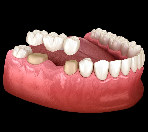 Restore Your Smile After Tooth Loss