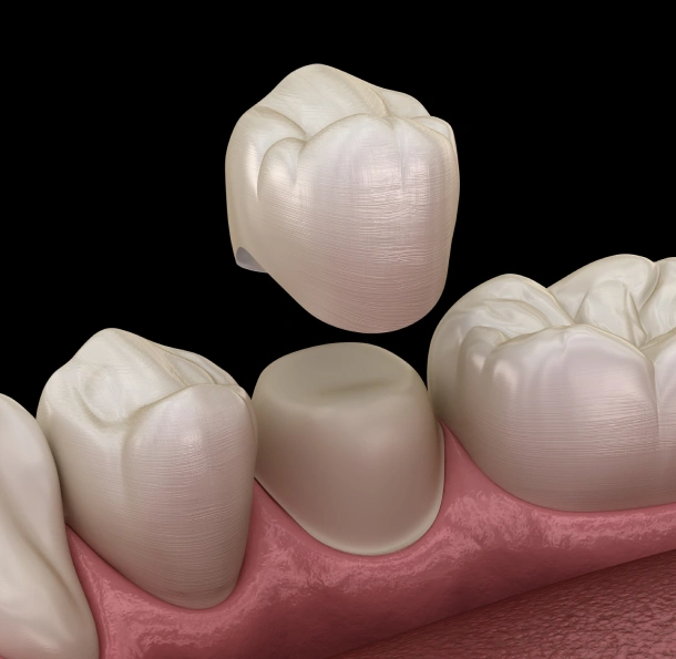 Restore Your Tooth the Same Weekend You Walk in