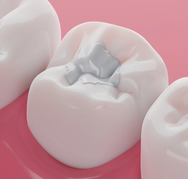 Natural-Looking White Fillings in Los Angeles